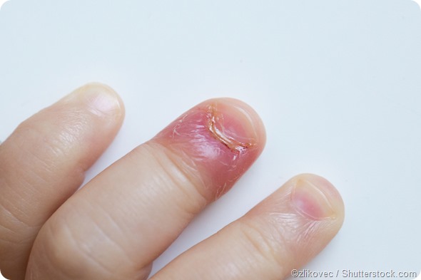 What are Nail Fold Infections (Paronychia)? - Thailand Medical News