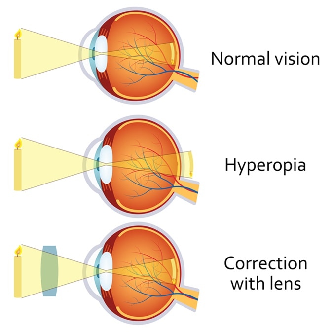 Latens hyperopia kezelése. A fejlődés okai