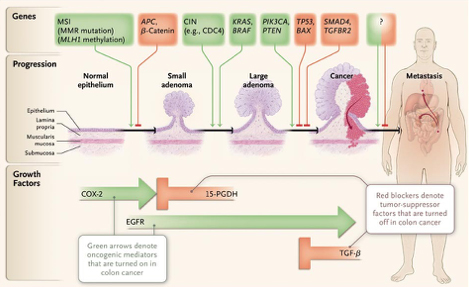 colon cancer