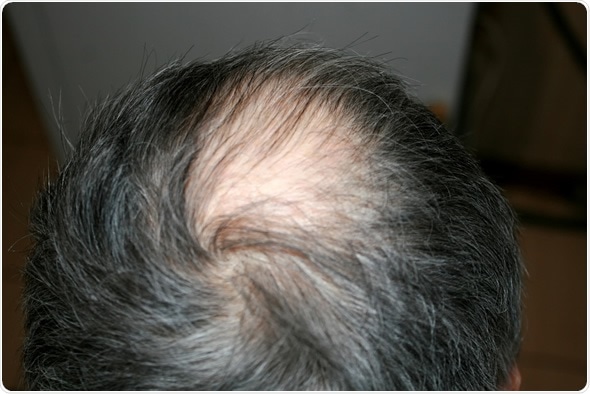 Medications that Can Cause Alopecia / Hair Loss - Thailand Medical News