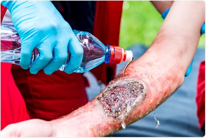 Medical worker treating burns on male's hand. First aid treatment outdoors. First aid practice. Imahe Credit: Microgen / Shutterstock