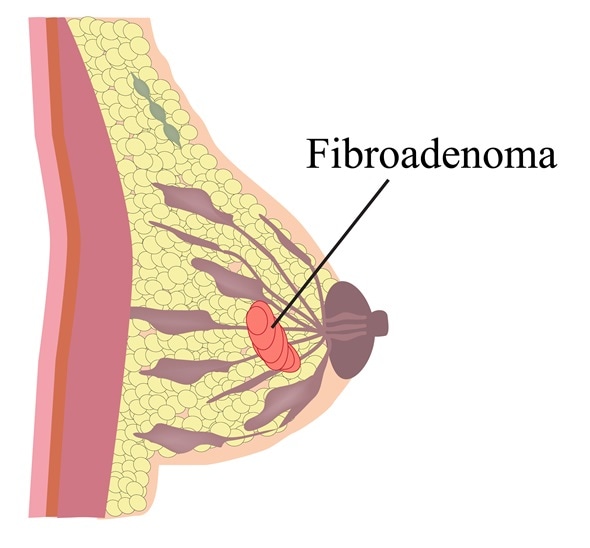 amely a fibroadenoma rák
