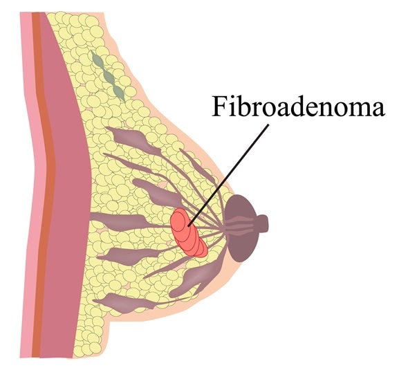 amely a fibroadenoma rák)