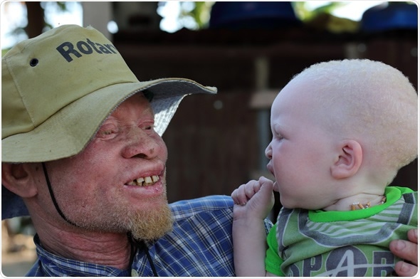 UKEREWE - TANZANIA - JULY 2, 2015: Unidentified albino father and son. Image Credit: Dietmar Temps / Shutterstock