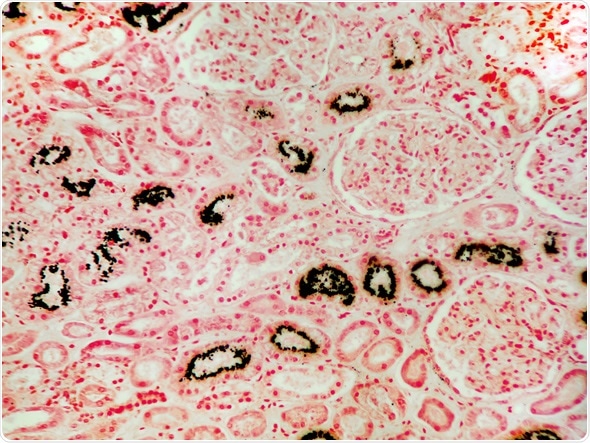 The condition of excess calcium and its resulting deposition in the kidneys. In this micrograph of kidney tissue, the calcium is shown stained black with a calcium stain. Image Copyright: Jubal Harshaw / Shutterstock