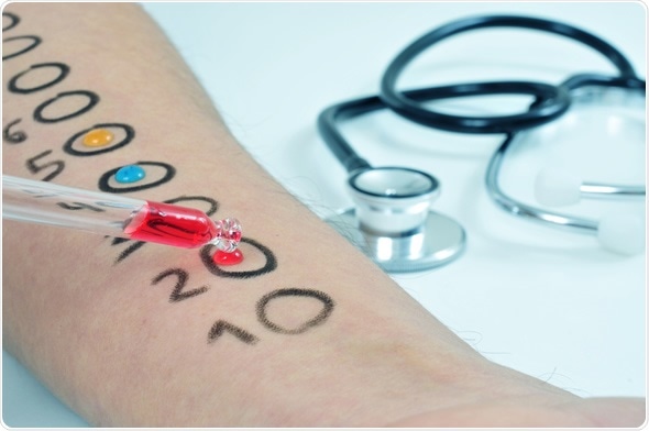 Closeup of the arm of a young man who is having a skin allergy test Copyright: nito / Shutterstock