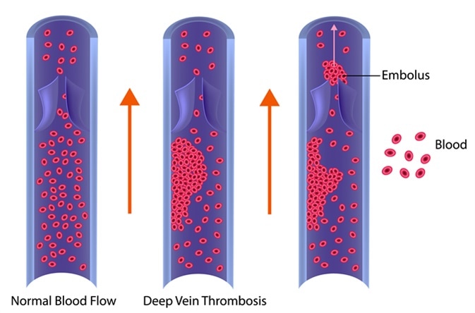 Deep Vein Thrombosis or Blood Clots. Embolus. Image Credit: Sakurra / Shutterstock