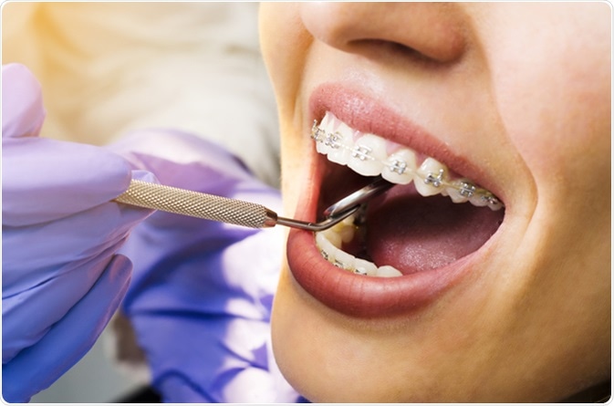 Closeup of young woman with braces dental checkup. Image Credit: Phoenixns / Shutterstock