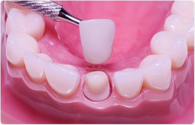 Dental crown installation process. Image Credit: Alex Mit / Shutterstock