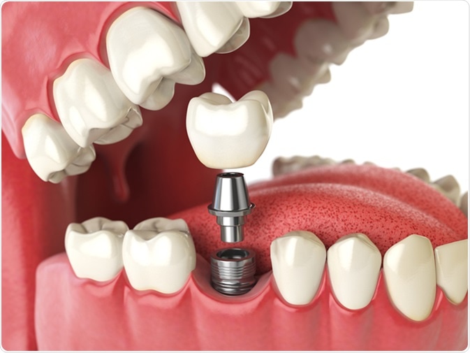 Tooth human implant. Dental concept. Human teeth or dentures. 3d illustration. Image Credit: Maxx-Studio / Shutterstock