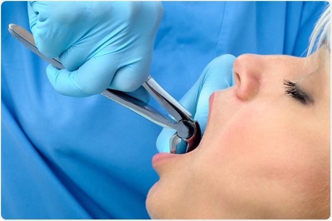 Dental extraction. Image Credit: Serghei Starus / Shutterstock