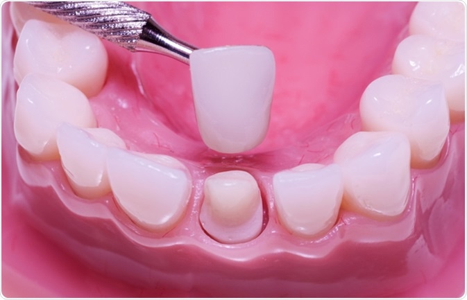 Porcelain Bonded Crown preparation, Bonded Crown. Image Credit: RCB Shooter / Shutterstock