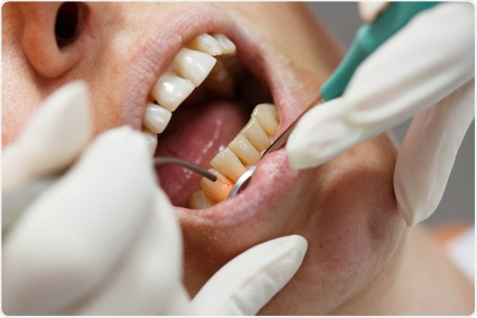 Dental laser used on a patient on soft and hard tissue. Image Credit: zlikovec / Shutterstock