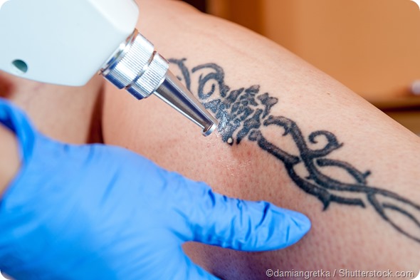 The Benefits and Risks of Laser Tattoo Removal - Thailand Medical News