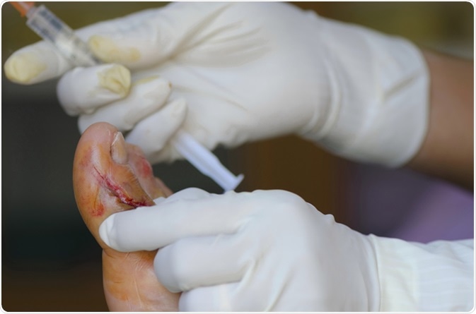 Laceration wound Injecting local anesthetics. Image Credit: Anukool Manoton / Shutterstock