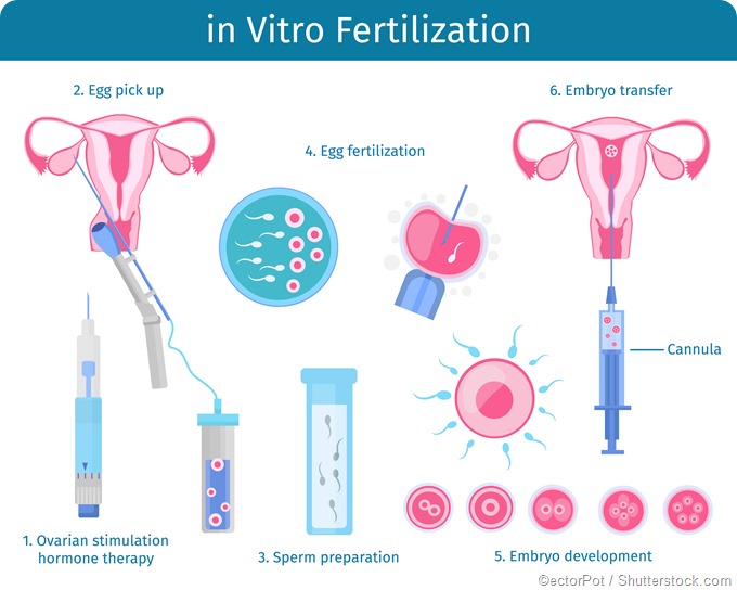 IVF process infographic
