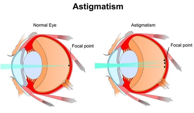 Astigmatism. Eye vision disorder. Diagram of the eye. Image Credit: Slave SPB / Shutterstock