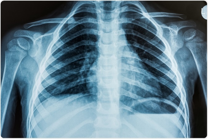 Chest X-ray of patient being tested for ARDS