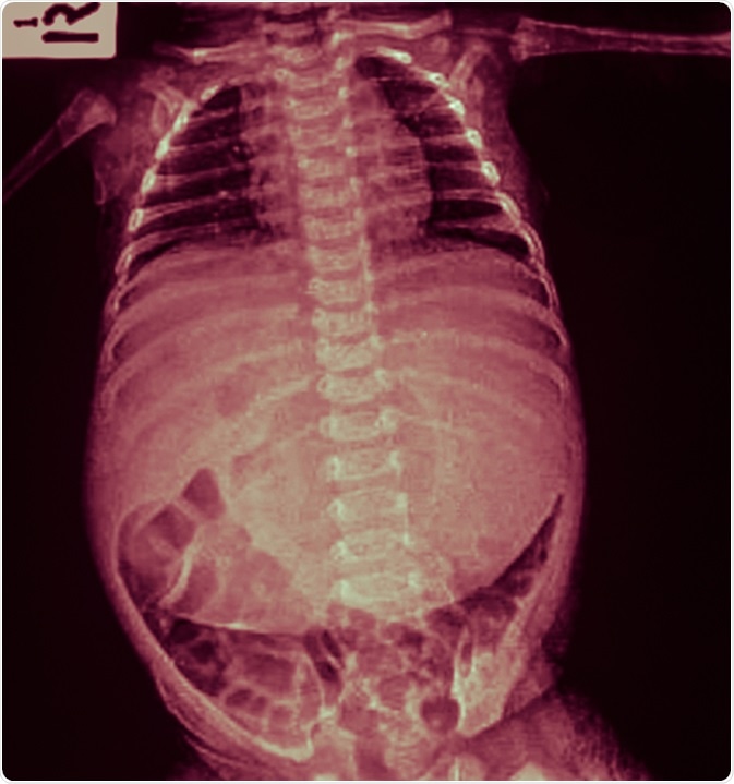 X-ray infant body and abdominal distension (flatulence, stomachache, pain). Image Credit: Tewan Banditrukkanka / Shutterstock