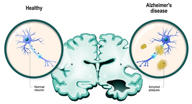 Human brain, in two halves: healthy and Alzheimer's disease. Healthy neuron and neuron with amyloid plaques. Image C