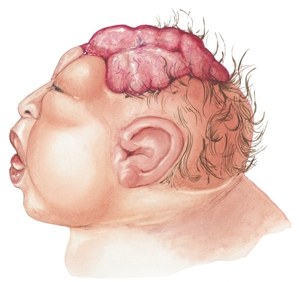 Anencephaly - Side View - is the absence of a large part of the brain and the skull. Occurs early in the development of an unborn baby. Results when the upper part of the neural tube fails to close. Image Copyright: Medical Art Inc / Shutterstock