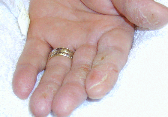 Optician - non-dominant hand dermatitis (allergy to ethyl acrylate)