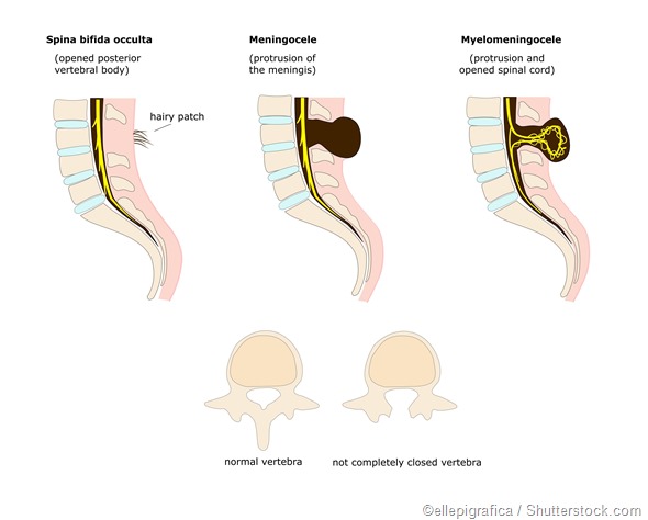 spina bifoda illustration