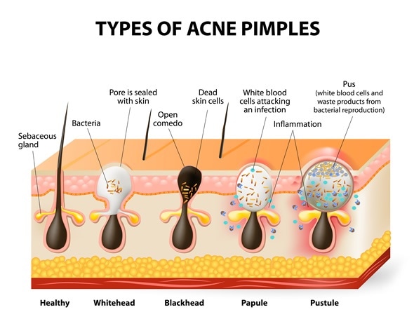 Types of acne pimples. Healthy skin, Whiteheads and Blackheads, Papules and Pustules - Image Copyright: Designua