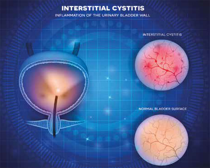 Interstitial Cystitis Diagnosis And Management Thailand Medical