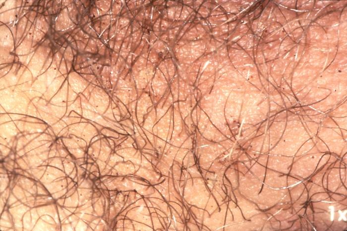 What Are Crabs Pubic Lice Thailand Medical News