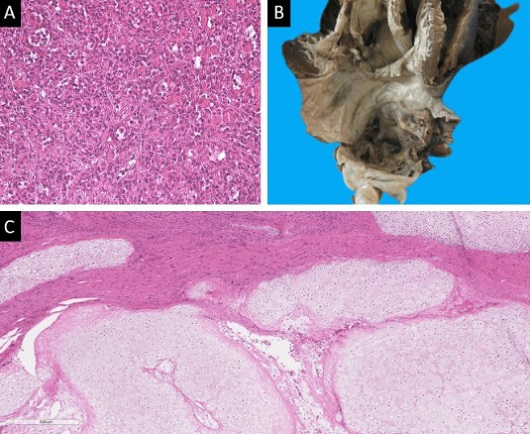 COVID-19-News-COVID-19-Increases-Risk-Of-Heart-Tumors-Including-Cardiac-Myxomas-And-Myxofibrosarcomas.jpg