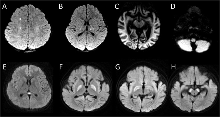COVID-19-News-MRI-Study-Reveals-High-Incidence-Of-Cerebrovascular-Lesions-In-Children-Infected-With-Omicron-Variants.jpg