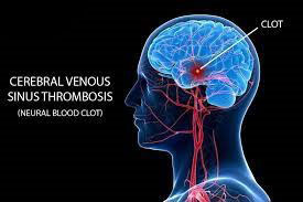 WARNING! Increasing Incidences Of Cerebral Venous Sinus Thrombosis ...