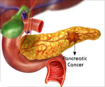 Cancer Identified