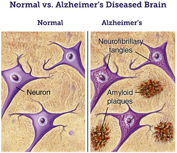 Discovery Of Amyloid Precursor Protein