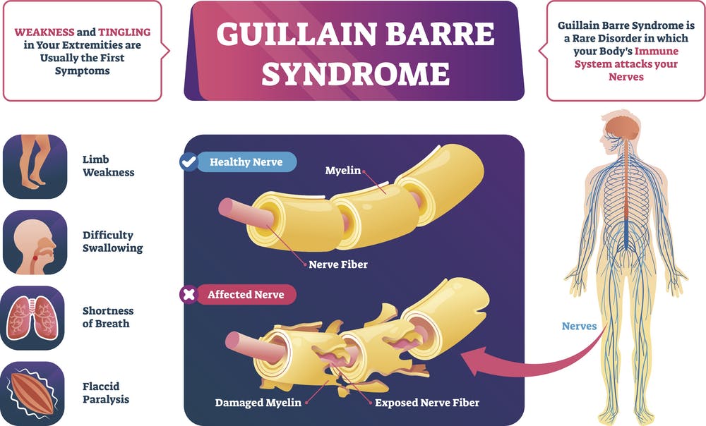 Breaking Guillain Barre Syndrome A Rare Neurological Disorder Manifesting In More Covid 19 Patients Thailand Medical News