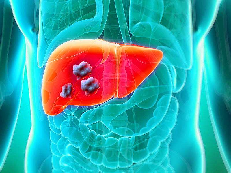 Liver Cancer: American Researchers Identify Metabolic Enzyme That  Accelerates The Growth And Spread Of Liver Cancer - Thailand Medical News
