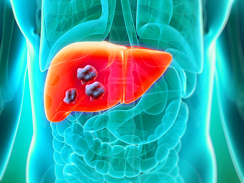 Liver Cancer American Researchers Identify Metabolic