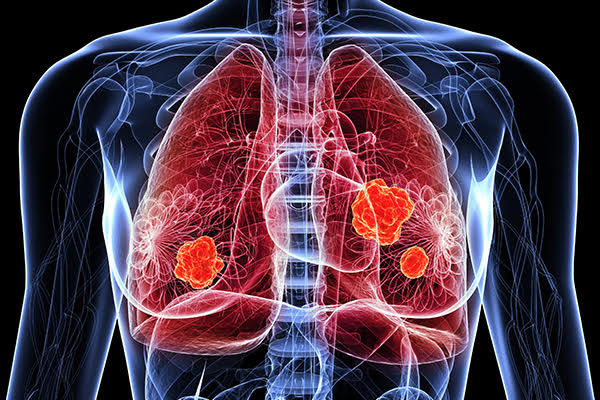 bevacizumab and mesothelioma