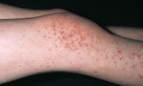 henoch schonlein purpura arthritis