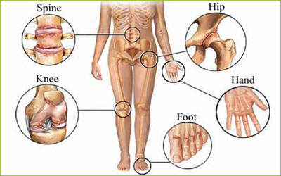 New approach to treatment that could stop knee and spine osteoarthritis