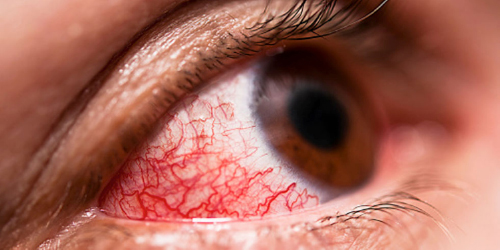 Pinkeye Disease