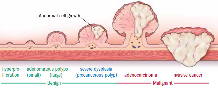 Pre-cancerous