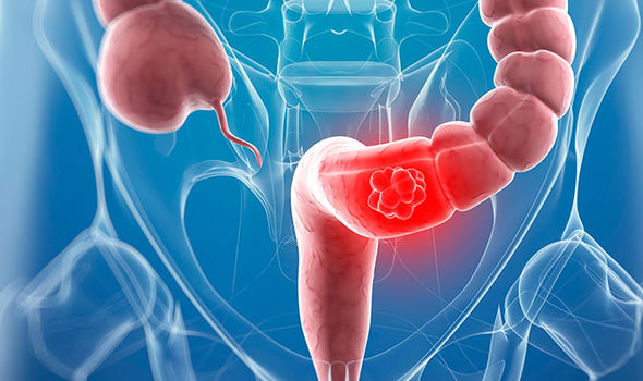 Researchers discover body protective mechanism against bowel cancer