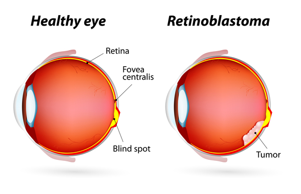 Retinoblastoma eye