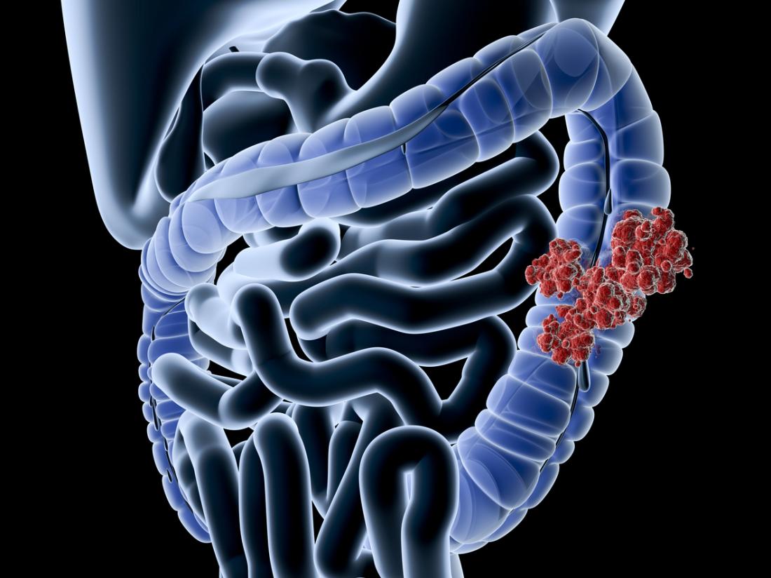 Scientists confirm correlation between colitis and colon cancer