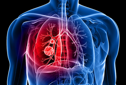 Shared genetic marker offers new promise in targeting specific ovarian and lung cancers