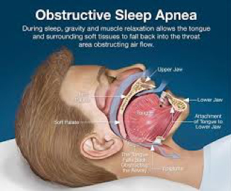 Sleep Disorder
