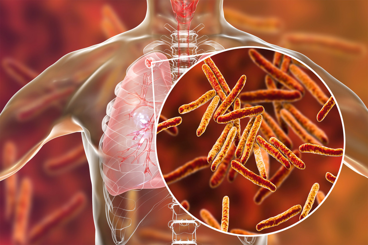 Tuberculosis Of The Bone Can Affect Which Of The Following Cloudshareinfo