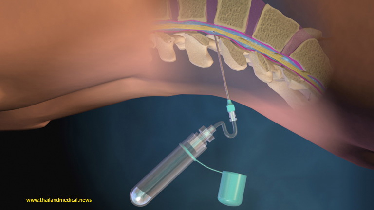 Using Cerebral Spinal